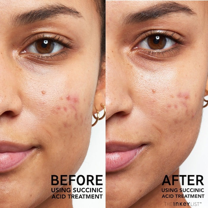 Succinic Acid Acne Treatment