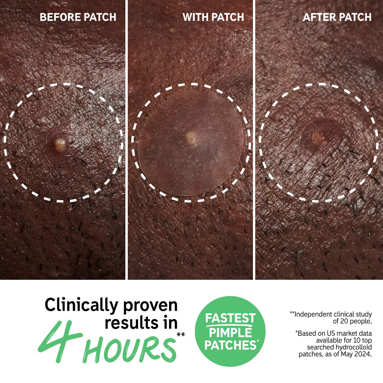 Hydrocolloid Invisible Pimple Patches